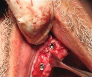 http://www.jdrntruhs.org/articles/2013/2/4/images/JNTRUnivHealthSci_2013_2_4_292_122177_f6.jpg