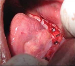 http://www.jdrntruhs.org/articles/2013/2/4/images/JNTRUnivHealthSci_2013_2_4_292_122177_f7.jpg